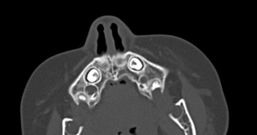 Choanal atresia (Radiopaedia 51295-56972 Axial bone window 5).jpg