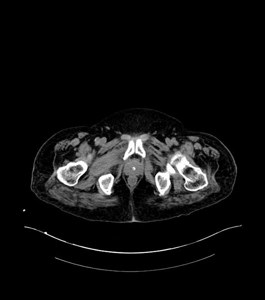 File:Cholangiocarcinoma with cerebral metastases (Radiopaedia 83519-98629 Axial non-contrast 129).jpg