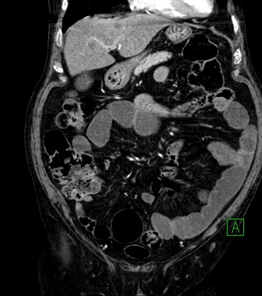 File:Cholangiocarcinoma with cerebral metastases (Radiopaedia 83519-98629 E 32).jpg