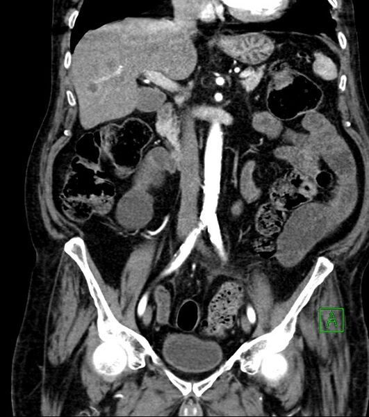 File:Cholangiocarcinoma with cerebral metastases (Radiopaedia 83519-98629 E 45).jpg
