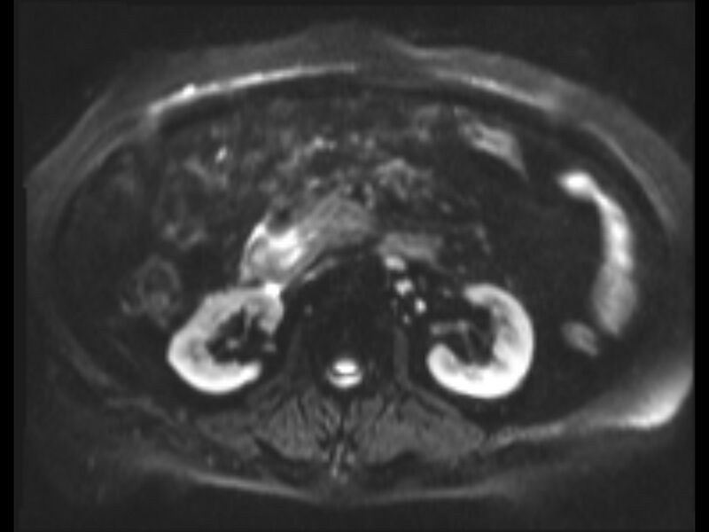 File:Choledocholithiasis causing intrahepatic biliary duct dilation (Radiopaedia 39908-42369 Axial T2 SPAIR 6).jpg