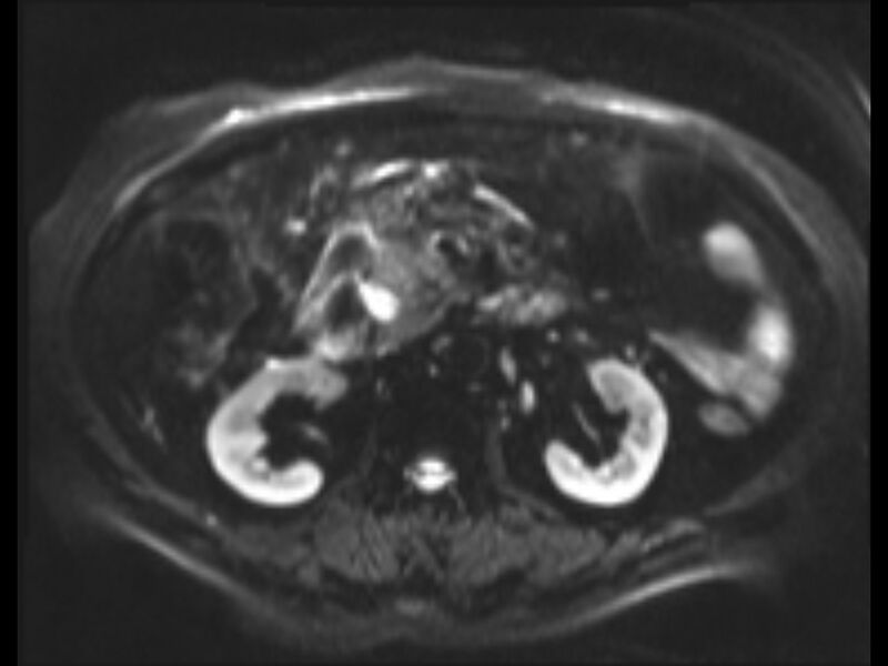 File:Choledocholithiasis causing intrahepatic biliary duct dilation (Radiopaedia 39908-42369 Axial T2 SPAIR 8).jpg