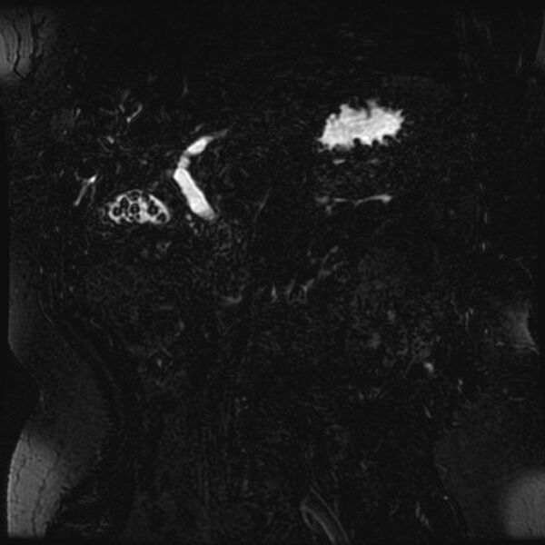 File:Choledocholithiasis on CT and MRI (Radiopaedia 24825-25088 Coronal T2 43).jpg