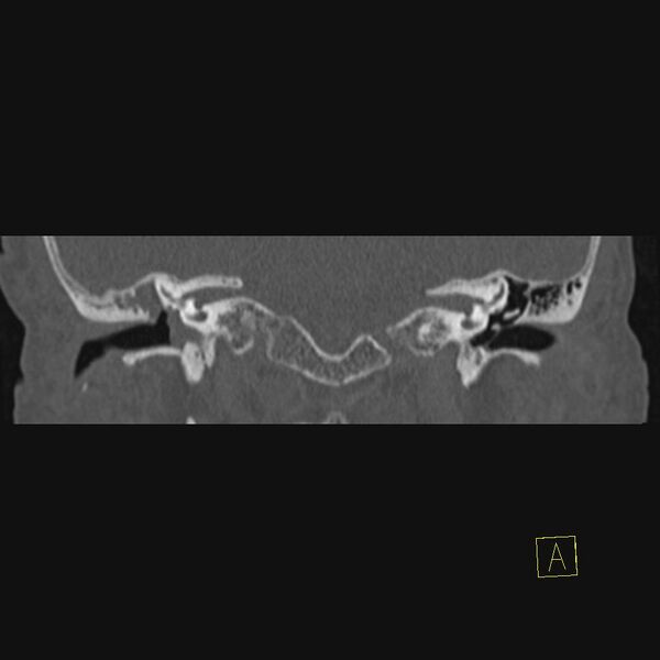 File:Cholesteatomatous chronic otitis (Radiopaedia 14993-14911 Coronal bone window 11).JPEG