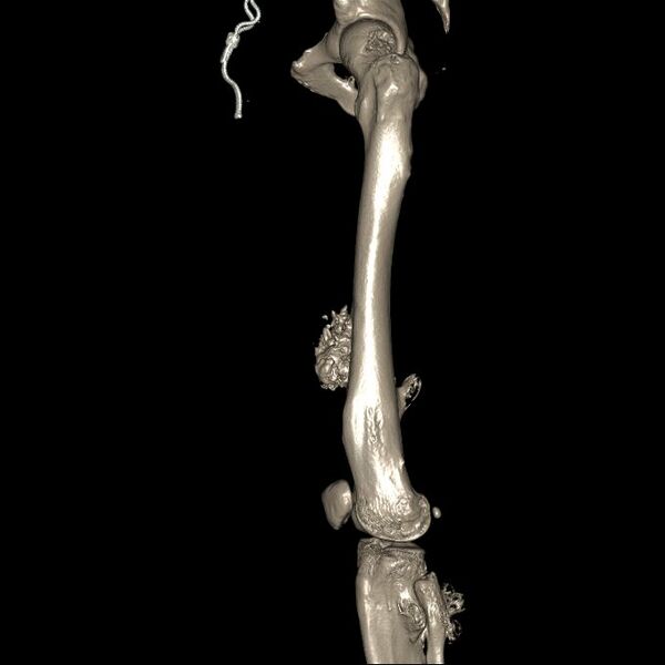 File:Chondrosarcoma arising from exostosis (Radiopaedia 59996-67507 3D Reconstruction 3).jpg