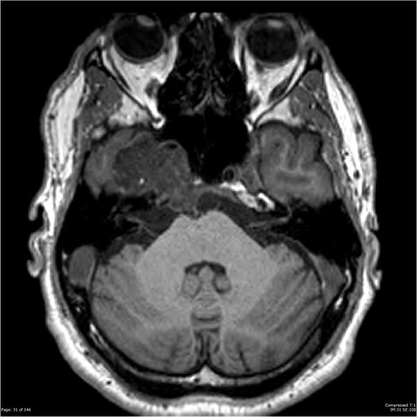 File:Chondrosarcoma of skull base- grade II (Radiopaedia 40948-43654 Axial T1 31).jpg
