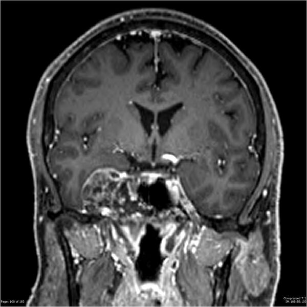 File:Chondrosarcoma of skull base- grade II (Radiopaedia 40948-43654 Coronal T1 C+ 19).jpg