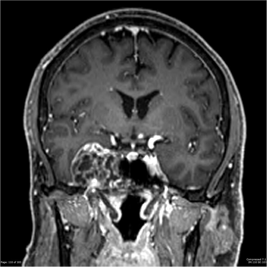 Chondrosarcoma of skull base- grade II (Radiopaedia 40948-43654 Coronal T1 C+ 21).jpg