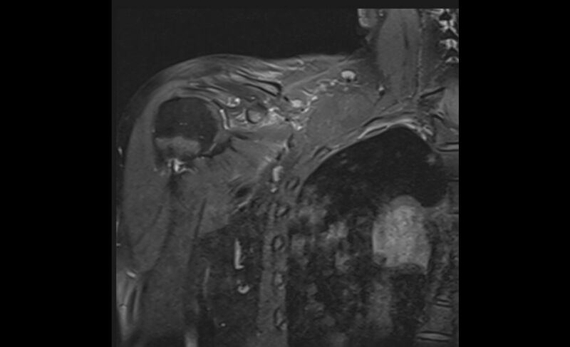 File:Choriocarcinoma in the shoulder (Radiopaedia 28603-28861 Coronal PD FS 6).jpg