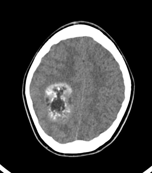 File:Choroid plexus carcinoma (Radiopaedia 91013-108552 Axial non-contrast 46).jpg