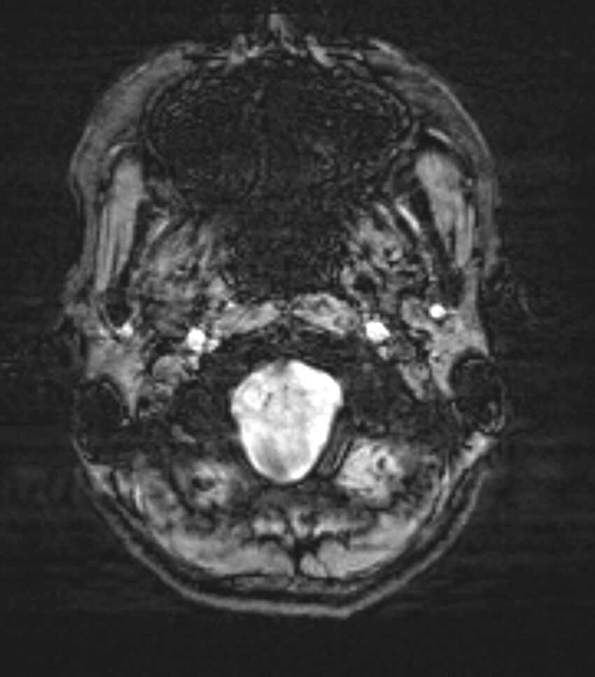 Choroid plexus carcinoma (Radiopaedia 91013-108553 Axial SWI 8).jpg