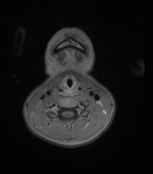 File:Choroid plexus carcinoma (Radiopaedia 91013-108553 Axial T1 C+ 10).jpg