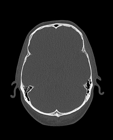 File:Chronic maxillary sinusitis caused by a foreign body (Radiopaedia 58521-65676 Axial bone window 303).jpg
