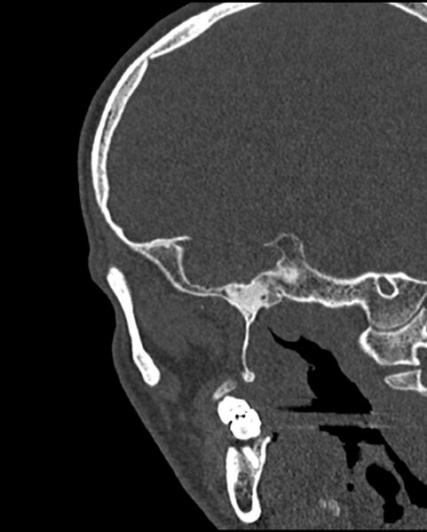 File:Chronic maxillary sinusitis caused by a foreign body (Radiopaedia 58521-65676 Sagittal bone window 68).jpg