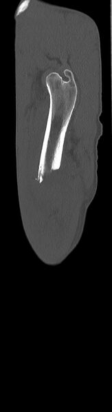 File:Chronic osteomyelitis (with sequestrum) (Radiopaedia 74813-85822 C 98).jpg