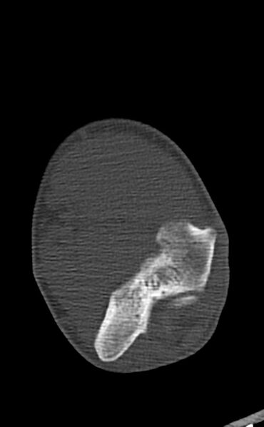 File:Chronic osteomyelitis of the distal humerus (Radiopaedia 78351-90971 Axial 34).jpg