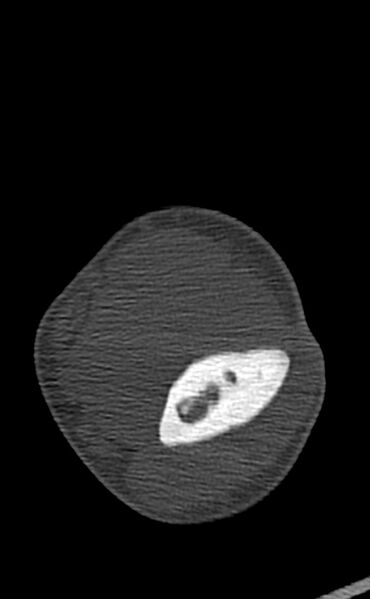 File:Chronic osteomyelitis of the distal humerus (Radiopaedia 78351-90971 Axial 8).jpg
