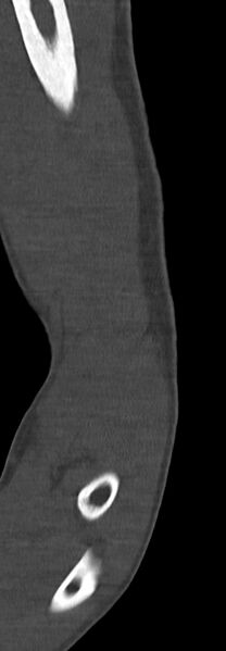 File:Chronic osteomyelitis of the distal humerus (Radiopaedia 78351-90971 Sagittal bone window 36).jpg