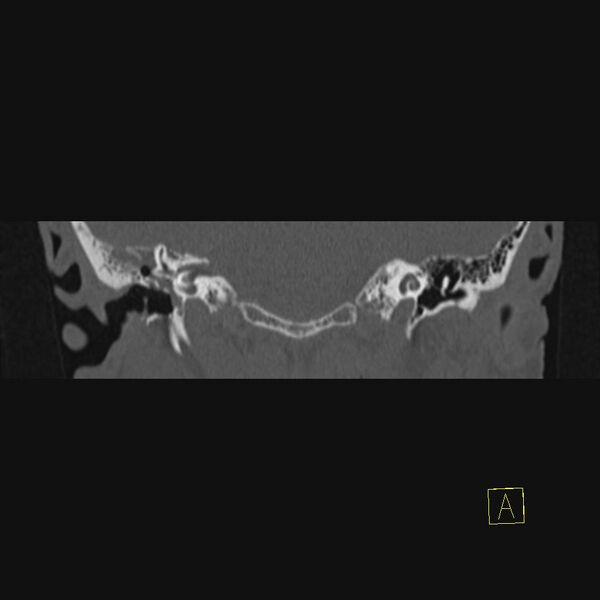 File:Chronic otitis media (Radiopaedia 14994-14912 Coronal bone window 11).JPEG