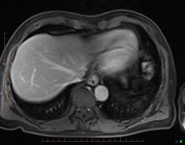 File:Chronic pancreatitis (Radiopaedia 17014-16716 Axial T1 C+ fat sat 1).jpg
