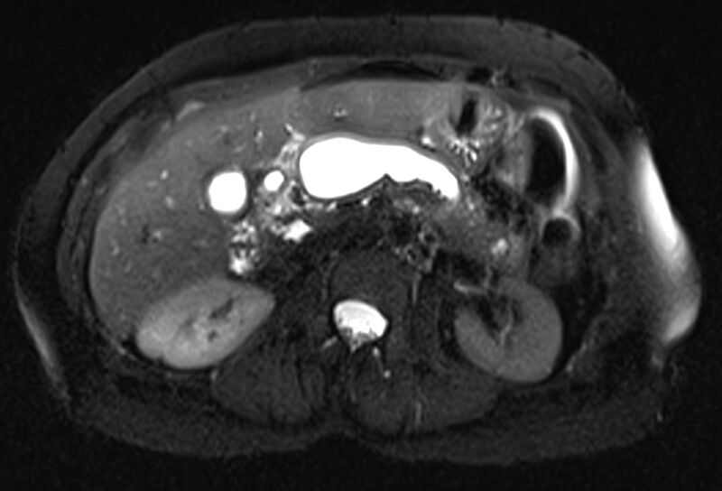 File:Chronic pancreatitis - pancreatic duct calculi (Radiopaedia 71818-82250 Axial T2 fat sat 29).jpg