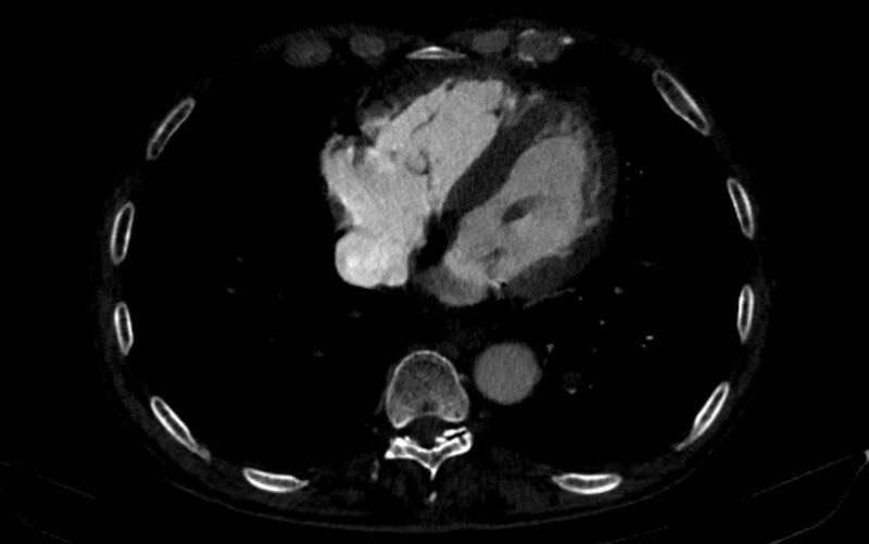 File:Chronic pulmonary embolism (Radiopaedia 91241-108843 B 136).jpg