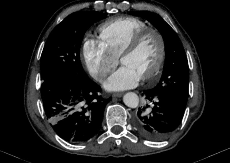 File:Chronic pulmonary embolism with bubbly consolidation (Radiopaedia 91248-108850 C+ arterial phase 103).jpg