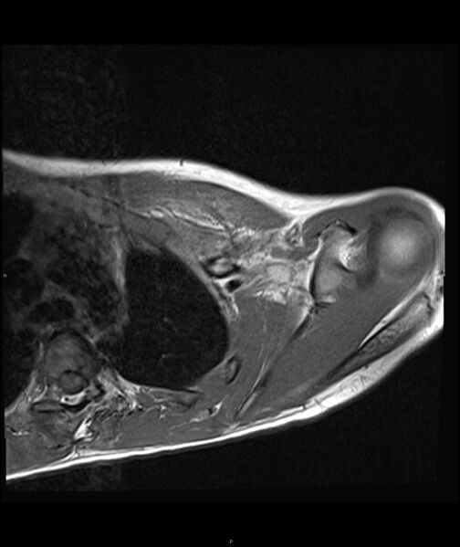 File:Chronic reactive multifocal osteomyelitis (CRMO) - clavicle (Radiopaedia 56406-63071 Axial T1 13).jpg
