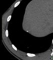 Chronic subcapsular hepatic hematoma (Radiopaedia 29548-30051 E 1).jpg