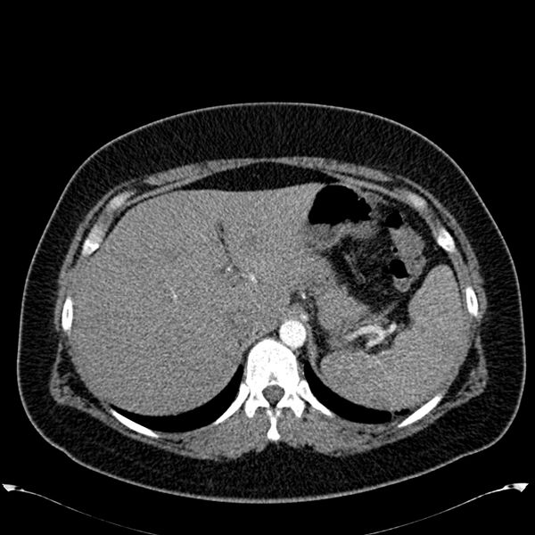 File:Chronic thromboembolic pulmonary hypertension (CTEPH) (Radiopaedia 74597-85531 Axial C+ CTPA 52).jpg