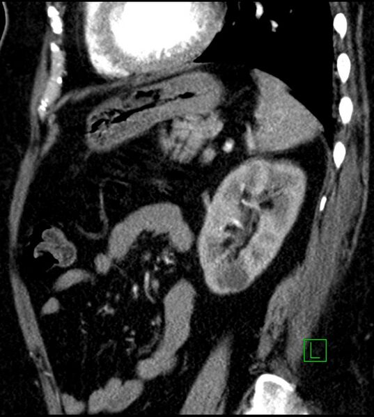 File:Clear cell renal cell carcinoma (Radiopaedia 85004-100537 D 20).jpg