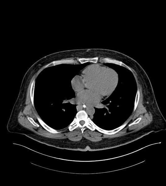 File:Closed-loop small bowel obstruction-internal hernia (Radiopaedia 78439-91096 Axial non-contrast 3).jpg