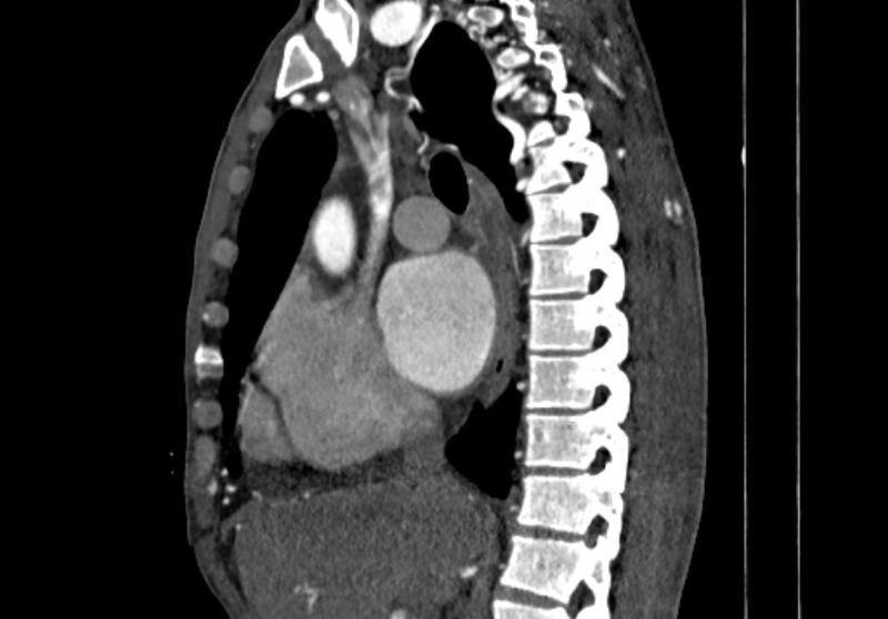 File:Coarctation of aorta with aortic valve stenosis (Radiopaedia 70463-80574 B 34).jpg
