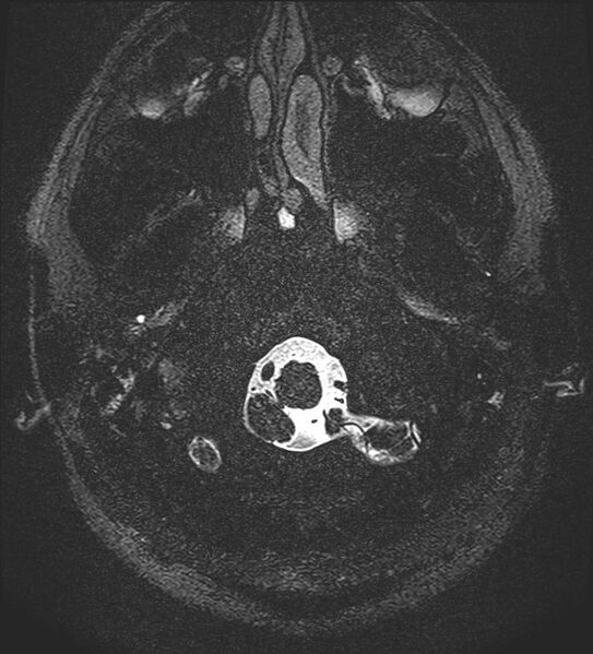 File:Cochlear incomplete partition type III associated with hypothalamic hamartoma (Radiopaedia 88756-105498 Axial T2 8).jpg