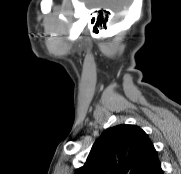 File:Colloid cyst of thyroid (Radiopaedia 22897-22923 Sagittal C+ delayed 13).jpg
