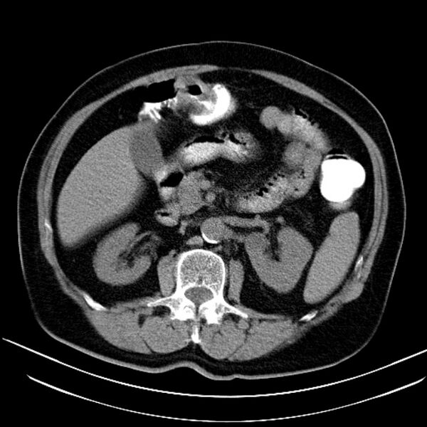 File:Colon adenocarcinoma (Radiopaedia 15157-15025 Axial non-contrast 3).jpg