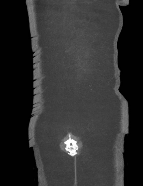 File:Colonic pseudo-obstruction (Radiopaedia 79752-92980 B 56).png