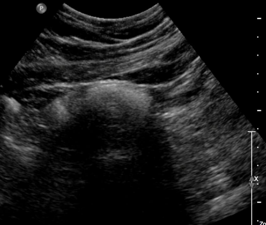 Figure 11.3A Ultrasound of female uterus, echogenic mass with acoustic shadowing.jpg
