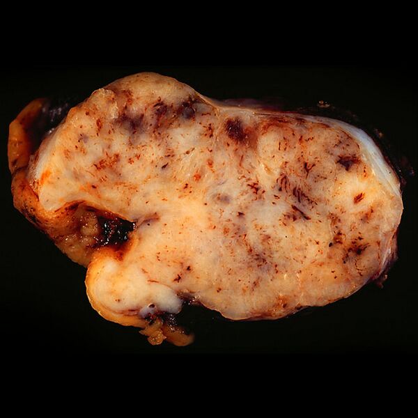 File:Gastrointestinal stromal tumor (gross pathology) (Radiopaedia 36400).jpg