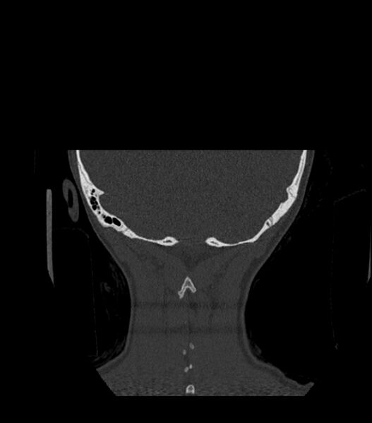 File:Nasoorbitoethmoid fracture (Radiopaedia 90044-107205 Coronal bone window 131).jpg