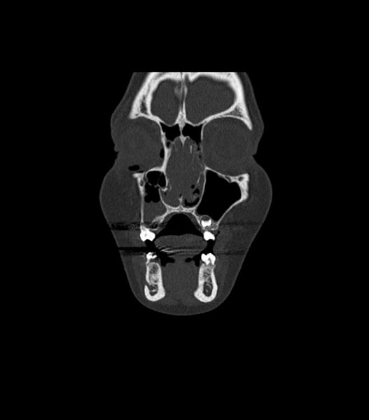 File:Nasoorbitoethmoid fracture (Radiopaedia 90044-107205 Coronal bone window 35).jpg