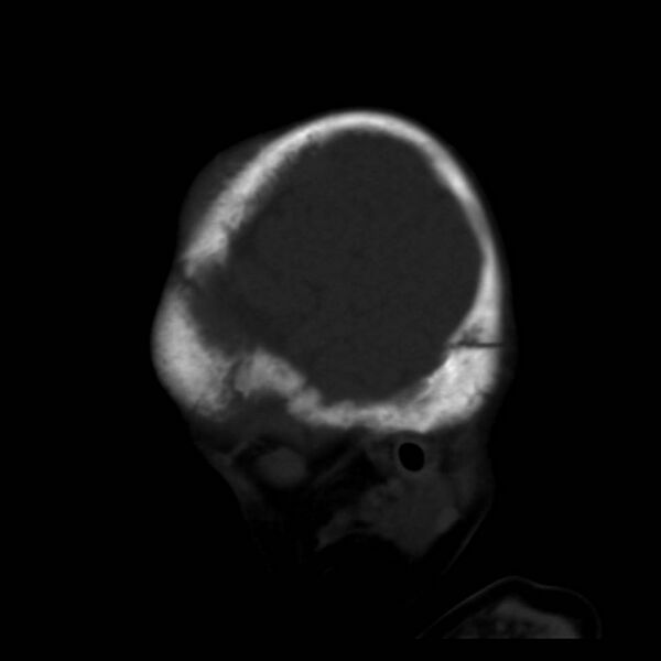 File:Neuroblastoma with skull metastases (Radiopaedia 30326-30958 Sagittal bone window 5).jpg