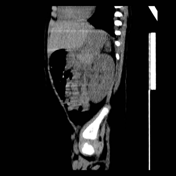 File:Neuroblastoma with skull metastases (Radiopaedia 30326-30960 B 31).jpg
