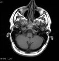 Neurosarcoidosis (Radiopaedia 10930-17204 Axial T1 3).jpg
