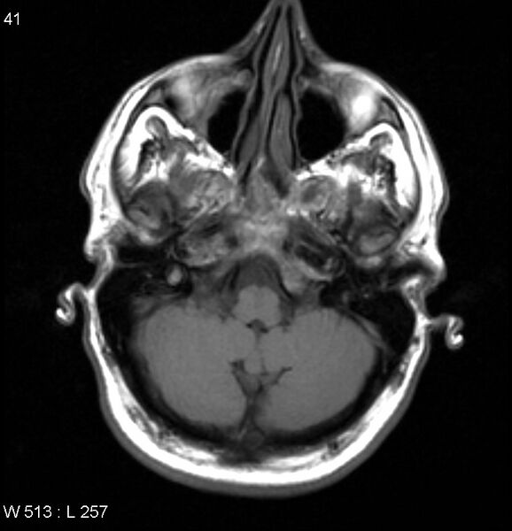 File:Neurosarcoidosis (Radiopaedia 10930-17204 Axial T1 3).jpg