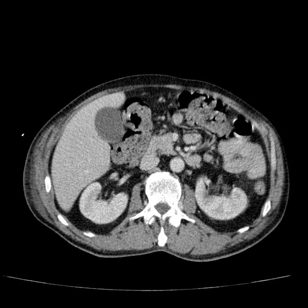 File:Non small-cell lung cancer (Radiopaedia 24467-24769 C+ delayed 72).jpg