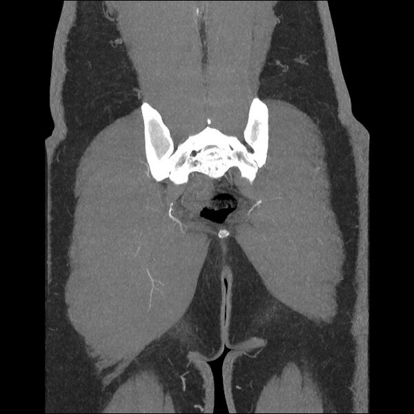File:Normal CT angiogram of pelvis (Radiopaedia 45390-49430 B 40).jpg