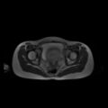 Normal MRI abdomen in pregnancy (Radiopaedia 88001-104541 Axial T2 65).jpg