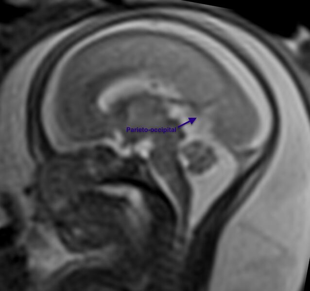 File:Normal brain fetal MRI - 22 weeks (Radiopaedia 50623-56604 Sulcation 5).jpg