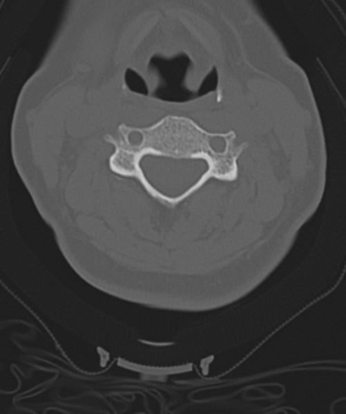 File:Normal cervical spine MRI (including Dixon) (Radiopaedia 42762-45926 Axial bone window 28).png